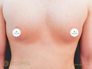 Sudetia-med-ginekomastia-PO-7