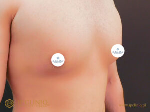 Sudetia-med-ginekomastia-PO-9