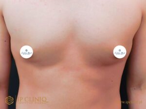 Sudetia-med-ginekomastia-PRZED-7