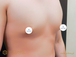 Sudetia-med-ginekomastia-PRZED-9